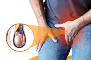 Natural Remedies for Getting Rid of a Spermatocele